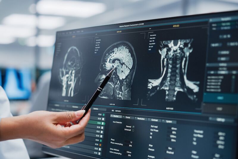 brain aneurysm doctor examining brain xrays